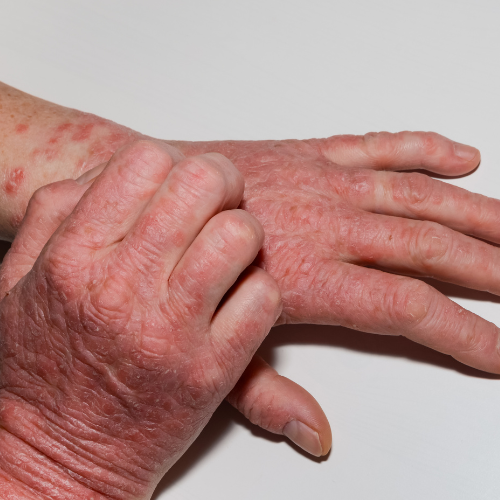 Psoriasis is a chronic, inflammatory skin condition that can significantly impact a patient's physical and mental health